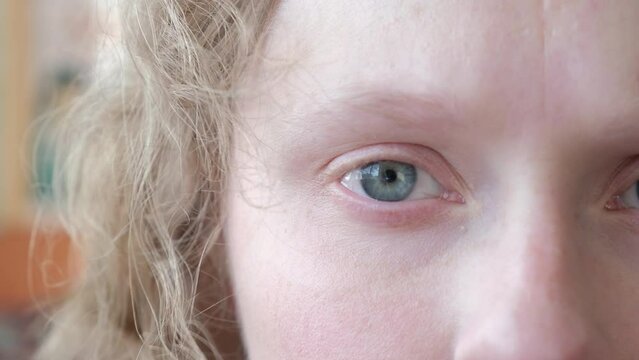 woman with nystagmus, uncontrolled rhythmic movements of the eyeballs, Pathological nystagmus