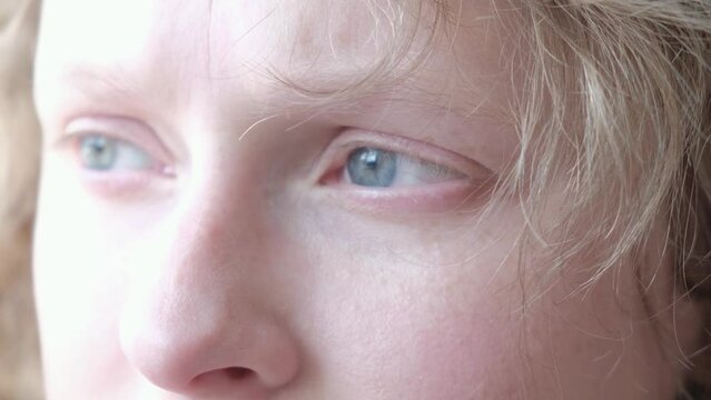 woman with nystagmus, uncontrolled rhythmic movements of the eyeballs, Pathological nystagmus