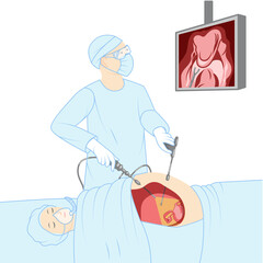 Laparoscopy keyhole surgery doctor with a patient surgical procedure Female Male reproductive system. Medical instruments with camera and screen. Human view in a cut illustration isolated flat icon