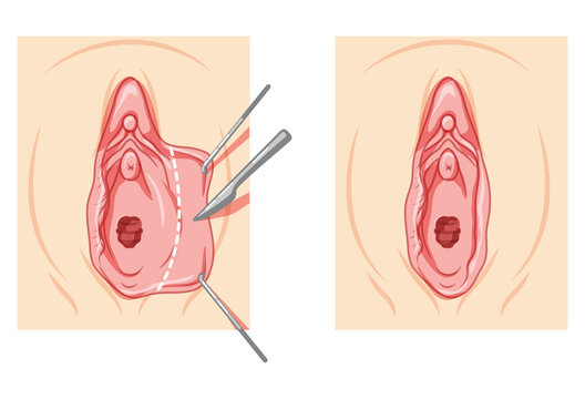 Labiaplasty Female reproductive system process and ready uterus. Vaginoplasty Front view. Human Surface anatomy of the perineum external organs location scheme, vagina pain vulva flat style icon
