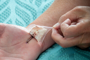 A female nurse removes a padded bandage on the wrist and hand of a woman. The palm has a number of black nylon stitches from a recent carpal tunnel surgery. The wound is closed with no infection.  - obrazy, fototapety, plakaty