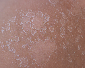 Fototapeta premium peeling of the skin after a sunburn as a background