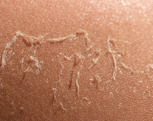 peeling of the skin after a sunburn as a background