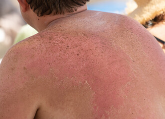 Naklejka premium peeling of the skin after a sunburn as a background