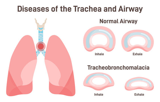 Tracheobronchomalacia. Airway And Bronchial Tubes Disease. Soft And Weak Trachea