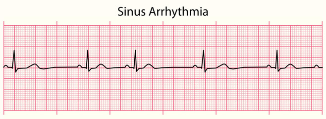 ECG line: Sinus Arrhythmia in 6 second ECG paper line