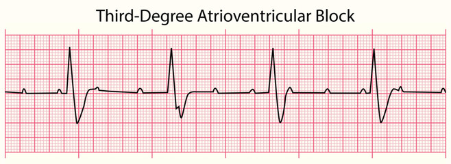 ECG line: Third-Degree Atrioventricular Block in 6 second ECG paper line
