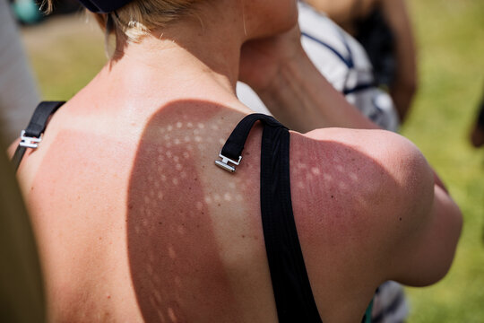The girl's back was burned in the sun, tan marks from the bright sun, the bra clasp, the view from the back of a person on vacation, summer holidays at sea.