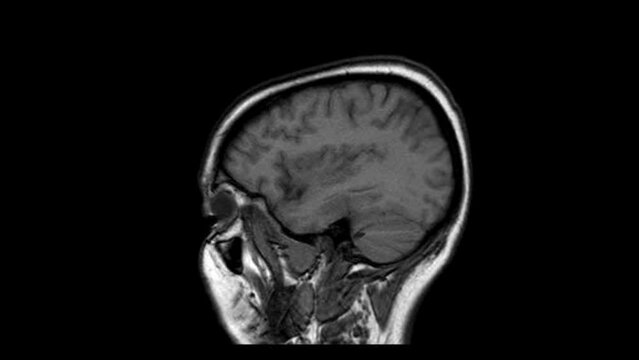 Magnetic resonance imaging of the skull in motion loop. In black and white. Lateral imaging brain. MRI.