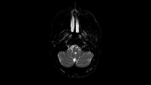  Skull magnetic resonance in movement. Black and white. Brain images. MRi