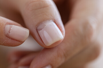 Cracked broken nail closeup. Nail weakness damage from gel polish coating.