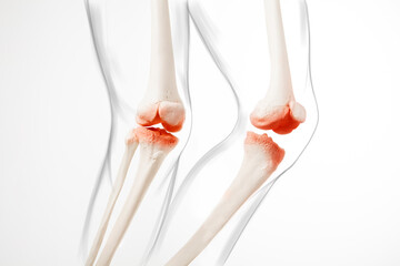 Knee meniscus pain, human legs, medically accurate representation of an arthritic knee joint