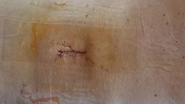 The scar on the back after spine surgery - herniated discs blocked nerves