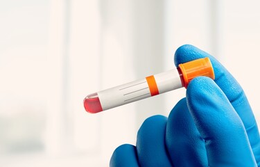 Blood sample tube for virus test. It is also known as the Moneypox virus,