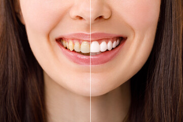 Smiling woman before and after the teeth whitening procedure, close-up image.