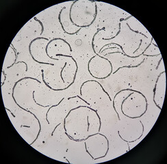 Microscopic image showing Hyphae of dermatophytes,  skin scraping for fungus test.