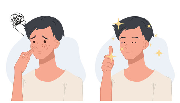 Skin care concept.man with acne.Before and after acne.Flat vector 2d cartoon character illustration.