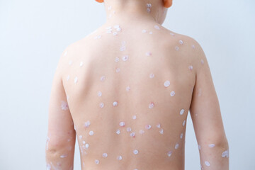 back of blonde little boy with red rashes Chicken pox virus, varicella with medical cream