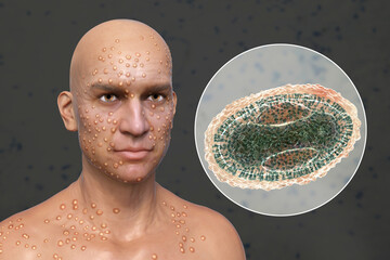 A man with smallpox disease and close-up view of variola virus, a virus from Orthopoxviridae family that causes smallpox - obrazy, fototapety, plakaty
