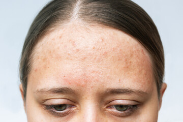 Close up of red allergic rash on a forehead. Cropped shot of young woman's face with acne problem....
