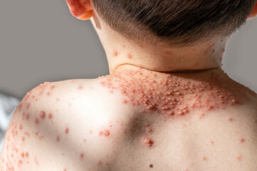 little baby boy with severe form of varicella,chickenpox virus.back view.lot of blisters on child...