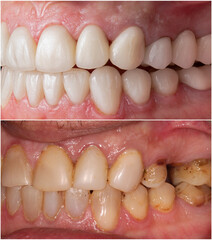 press ceramic crowns and veneers