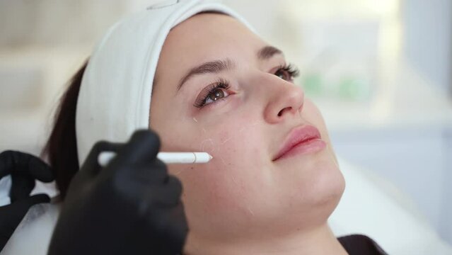 Beautician marking face for filler injection