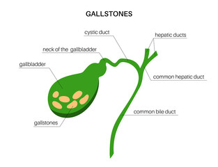 gallbladder stones anatomy