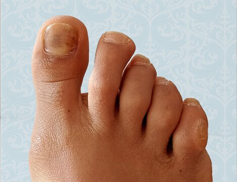 Callo o heloma duro del quinto dedo del pie de una mujer por usar calzado estrecho o apretado en fondo claro.