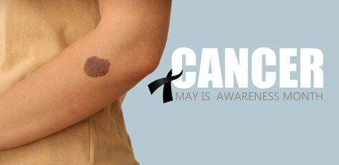 Young woman with birthmark, closeup. Skin cancer awareness month