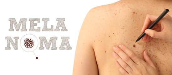 Doctor applying marks on human body. Melanoma concept