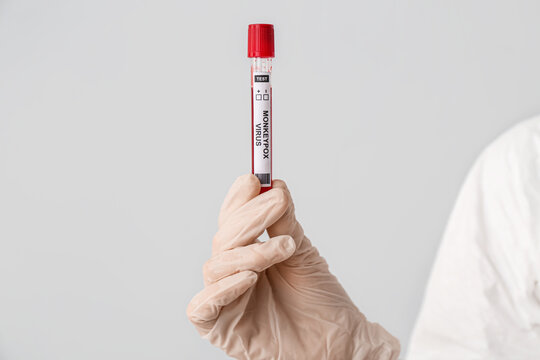 Scientist with sample of monkeypox virus on light background, closeup - Powered by Adobe