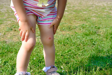 fresh wound, bleeding abrasion on knees of girl child fell on walk, traumatic safety concept for...