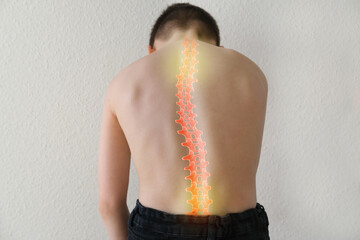 part of naked back of boy, child 8-10 years old is standing, hunched over from back pain, concept of therapeutic massage for osteochondrosis, scoliosis, back pain, intervertebral hernia - obrazy, fototapety, plakaty