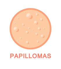 Papilloma Virus. Warts on Human Skin. Icon. Color Cartoon style. Closeup view. White background. Vector illustration for Medical and Educational Design.