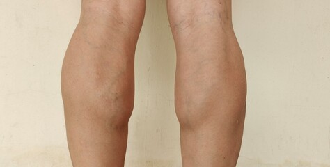 Portrait showing the calf muscles of runner, problem wrinkles and varicose veins of the woman,...
