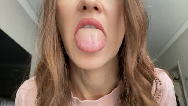 Tongue Swelling After an Insect Bite by a Wasp or Bee. Allergy with angioedema