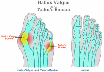 Tailor 's Bunion, hallux valgus anatomy. Foot bones, joint deformity feet. Top foot x ray, angle of  little pinky, big toe symptom structure. Orthopedic patients surgery. Illustration medical vector - obrazy, fototapety, plakaty