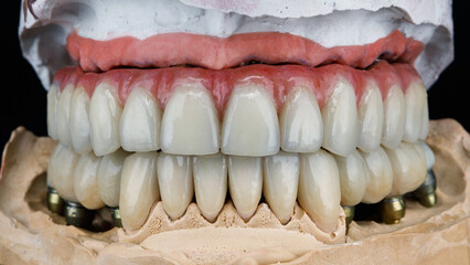 dental prosthesis of the upper jaw and crowns on the model in the bite © Dental Pro Content