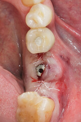 dental gingiva former after implantation