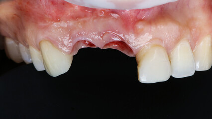 upper jaw without two central teeth before crowns