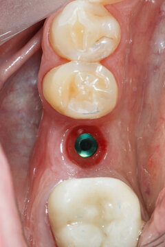 beautiful macro photo of the installed dental implant and healthy gums