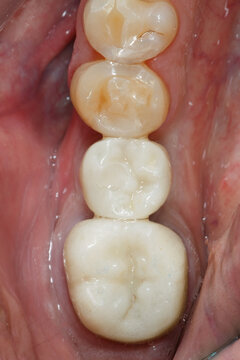 installed dental crown of the chewing tooth