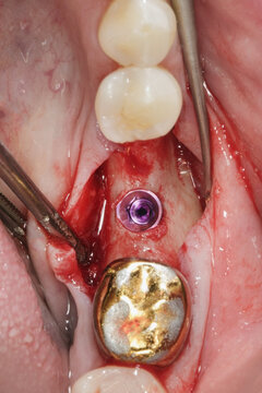 macro dental photo of the installed implant in the bone