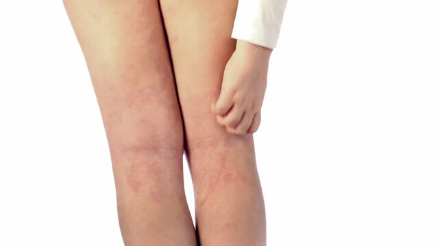 Acute atopic dermatitis on the legs behind the knees of a child is a dermatological disease of the skin. Large, red, inflamed, scaly rash on the legs. Legs of a teenager with severe atopic eczema.