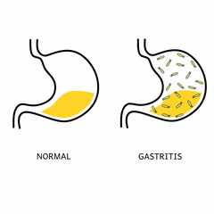 Vector illustration of gastritis digestive disease poster. Infographic comparison of the anatomy of a normal stomach with gastritis stomach. Digestive tract disorders. Health care and medical.