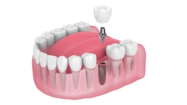 dental implant placement into lower jaw over white background