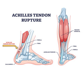Achilles tendon rupture as painful injury and leg trauma outline diagram. Labeled educational anatomical scheme with orthopedic problem explanation vector illustration. Medical body muscle condition.
