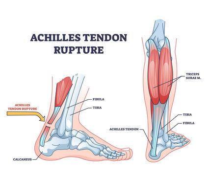 Achilles tendon rupture as painful injury and leg trauma outline diagram. Labeled educational anatomical scheme with orthopedic problem explanation vector illustration. Medical body muscle condition.