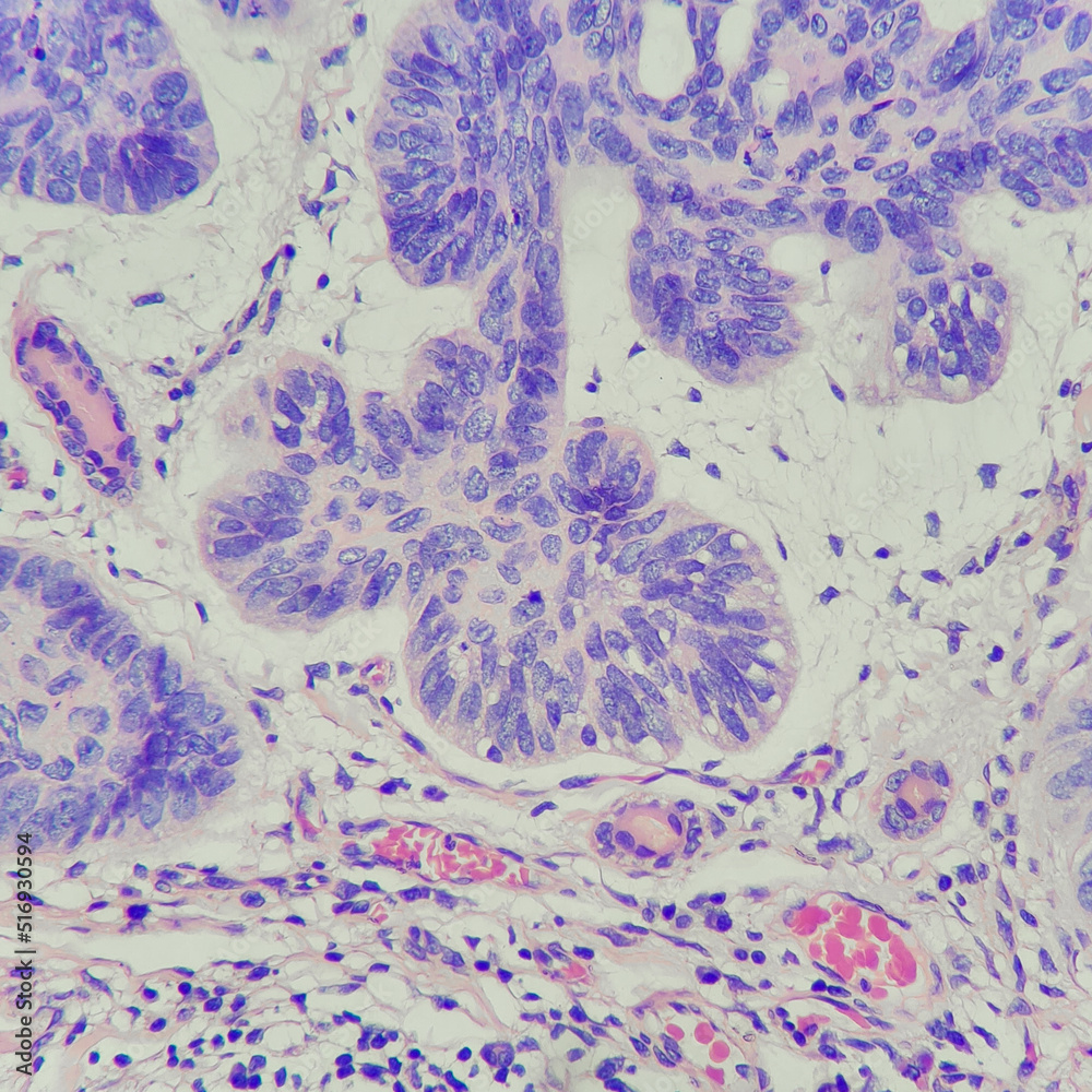 Poster Camera photo of basal cell carcinoma of the skin tissue, showing tumor sheet with cleft artifact, magnification 400x, photograph through a microscope